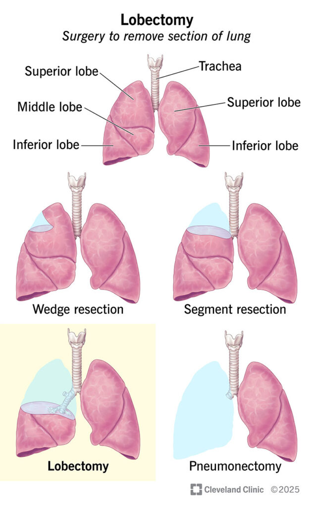 lobectomy
