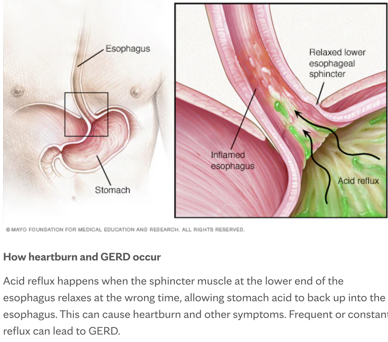 GERD