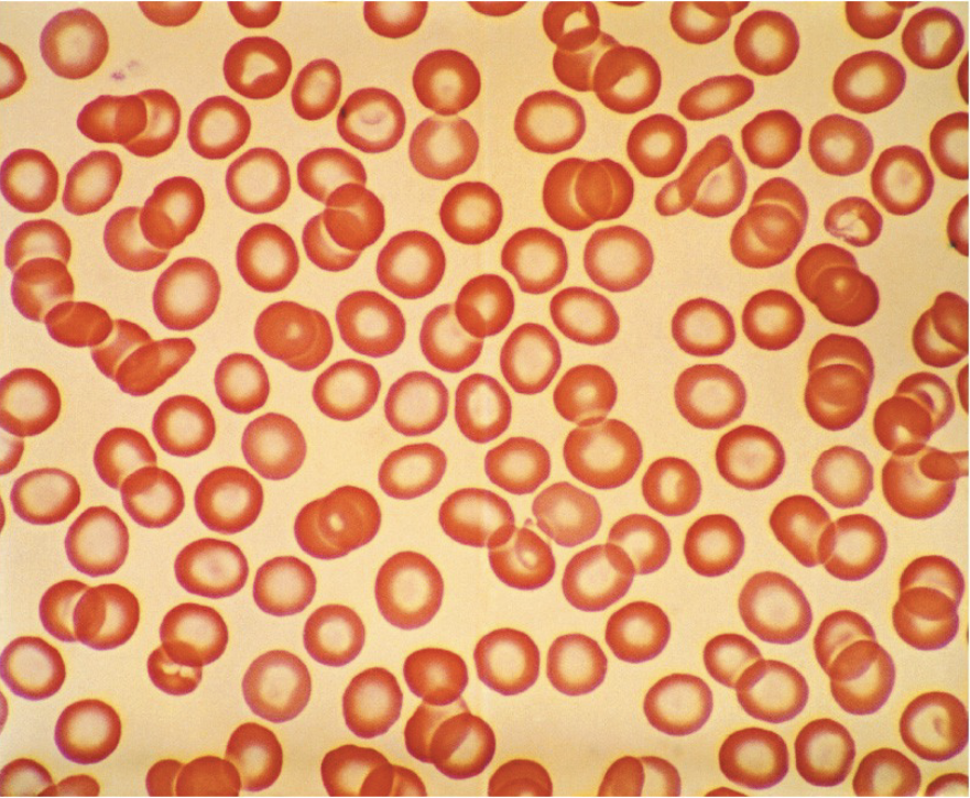Under a microscope, this person’s blood has many centrally pale erythrocytes that are microcytic, hypochromic, and characteristic of iron deficiency anemia.
