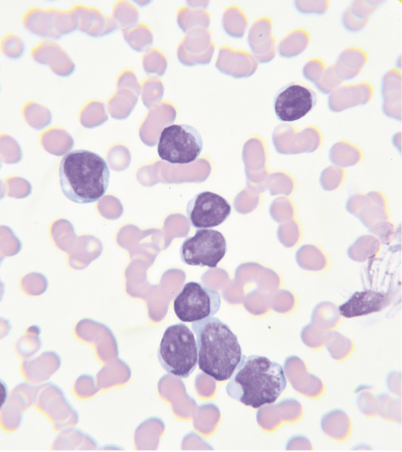 This blood sample was taken from a patient with acute lymphoblastic leukemia. There was a sudden and dramatic
increase in the number and size of immature lymphoblasts; only a few, smaller mature normal lymphocytes still remain
in the blood. The pale cells in the background are erythrocytes.